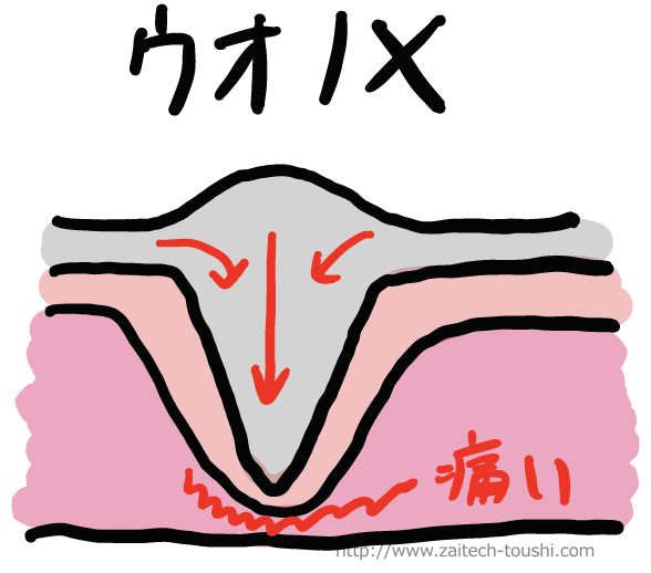 スピール膏で魚の目除去をした話